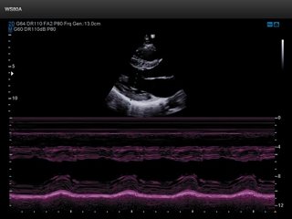 Heart - left ventricle, M-mode