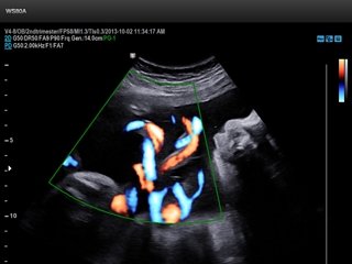 Umbilical cord, S-Flow