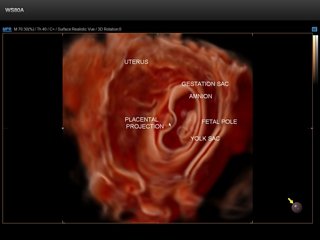 Embryo, Crystal Vue 3D