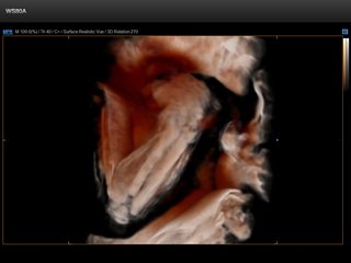 Fetus - ulna and radius, Crystal Vue 3D