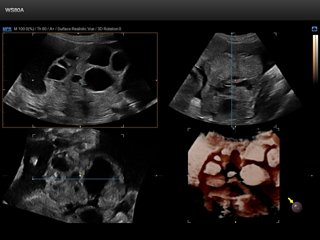 Ovarian follicles, 5D follicle