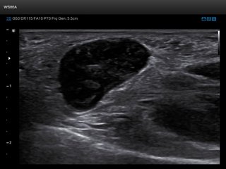 Muscle - volumetric formation, B-mode