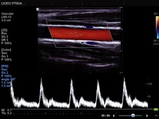 Common carotid artery, CFM & PW