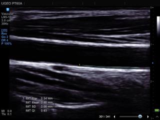 Common carotid artery, Auto IMT