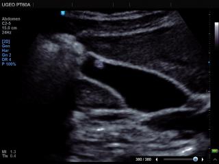 Gall bladder - polyp, В-mode