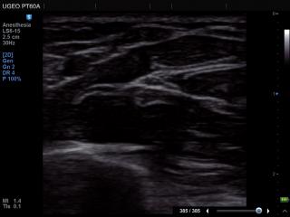 Median nerve, MultiVision