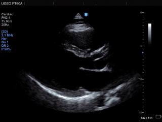 Heart (long axis of LV), B-mode