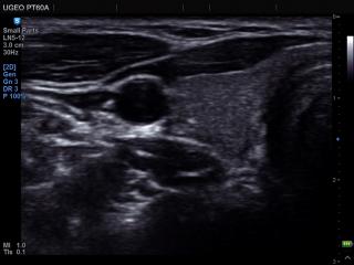 Thyroid, MultiVision