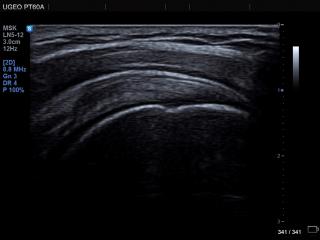 Supraspinatus tendon, MultiVision