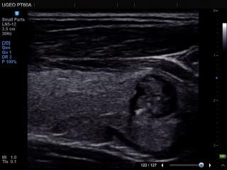 Thyroid - nodule, ClearVision