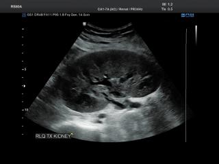 Renal transplant, B-mode