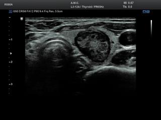 Thyroid - nodule, B-mode