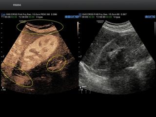 Kidney, CEUS+ and FlowMax