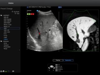 Liver, S-Fusion