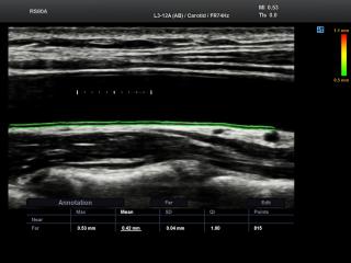 Common carotid artery, Auto IMT