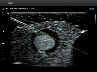 Thyroid, S-Tracking