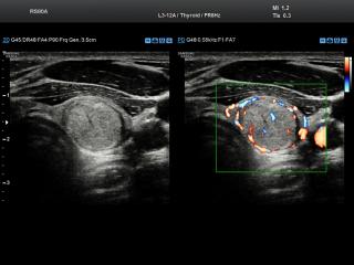 Thyroid - nodule, power doppler