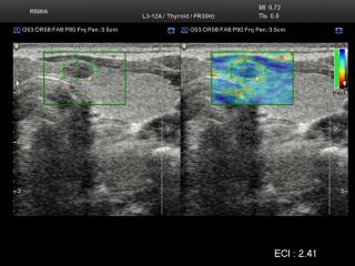 Thyroid, elastography