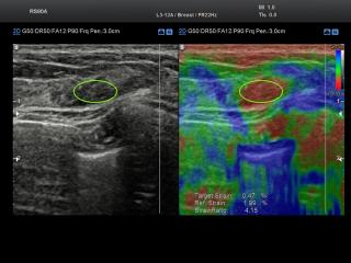 Breast, elastography