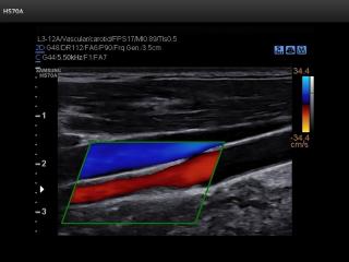 CCA and jugular vein, color doppler