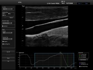 Common carotid artery, Arterial analysis