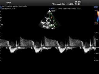 Pulmonary regurgitation, CFM & CW