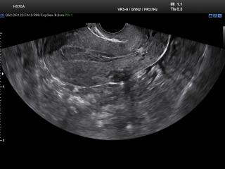 Uterus, B-mode