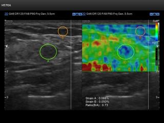 Breast, elastography