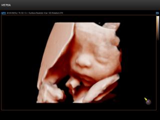 Fetus - face, Realistic Vue 3D