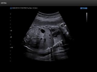 Fetus - abdomen, B-mode