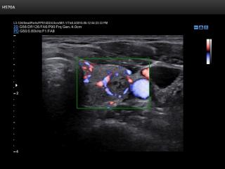 Thyroid - nodule, S-Flow