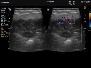 Kidney - nephroblastomatosis, B-mode & color doppler
