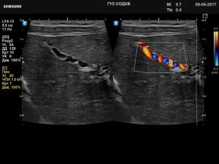 Liver - autoimmune hepatitis, B-mode & color doppler