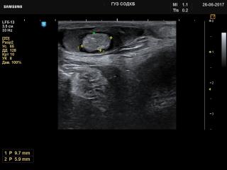 Testicle - dermoid cyst, B-mode