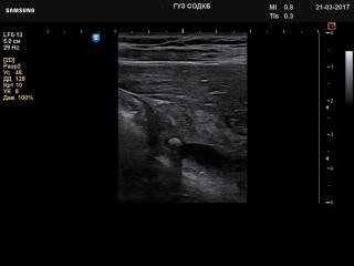 Choledochus - gallstone, B-mode