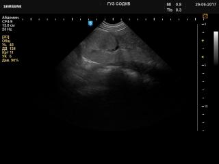 Kidney - renal dysplasia, B-режим