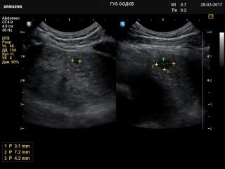 Thymus - cyst, B-mode