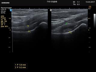 Hip joint - inflammation, B-mode