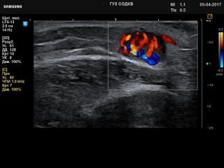 Forearm - soft tissue lesion, color doppler