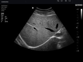 Liver, B-mode