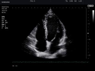 Heart (4 chamber view), B-mode