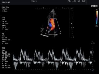 Mitral valve, CFM & PW