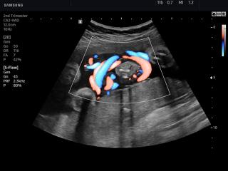 Umbilical cord, S-Flow