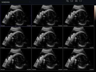 Fetal brain, MSV