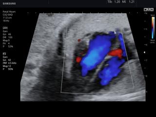 Fetal heart, color doppler