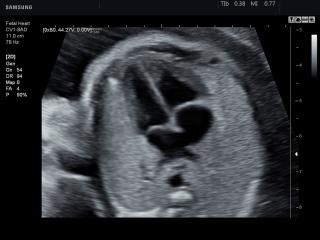 Fetal heart (4 chamber view), B-mode