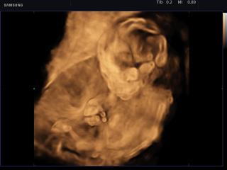 Fetus - 21 weeks, Crystal Vue, 3D