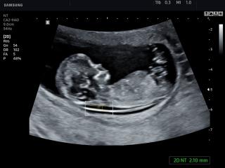 Fetus - nuchal translucency, 2D NT