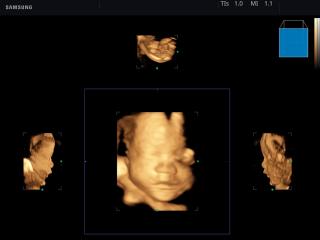 Fetus, Mirror View, 3D