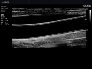 Common carotid artery, B-mode